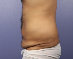 Liposuction Before and After