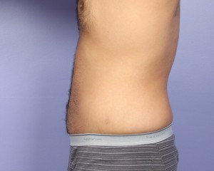 Liposuction Before and After