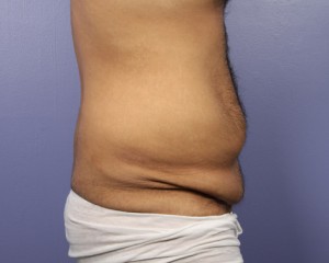 Liposuction Before and After