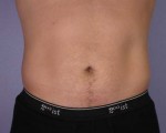 Liposuction Before and After Photo