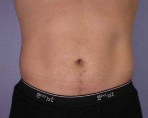 Liposuction Before and After