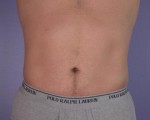 Liposuction Before and After Photo