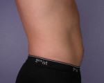 Liposuction Before and After Photo