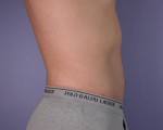 Liposuction Before and After Photo