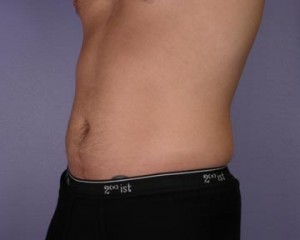 Liposuction Before and After