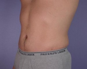 Liposuction Before and After