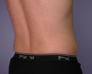 Liposuction Before and After