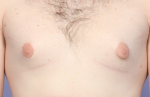 Male Breast Reduction Before and After