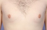 Male Breast Reduction Before and After Photo