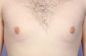Male Breast Reduction Before and After