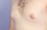 Male Breast Reduction Before and After Photo