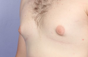 Male Breast Reduction Before and After