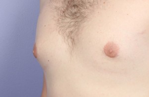 Male Breast Reduction Before and After