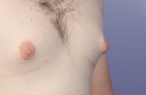 Male Breast Reduction Before and After