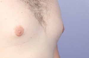 Male Breast Reduction Before and After