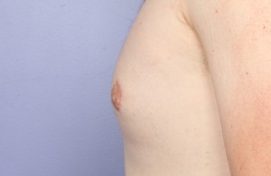 Male Breast Reduction Before and After