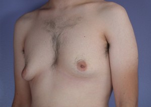 Male Breast Reduction Before and After