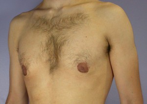 Male Breast Reduction Before and After