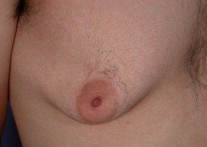 Male Breast Reduction Before and After