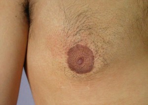 Male Breast Reduction Before and After