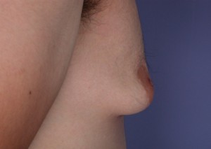 Male Breast Reduction Before and After