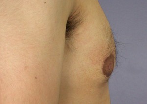 Male Breast Reduction Before and After