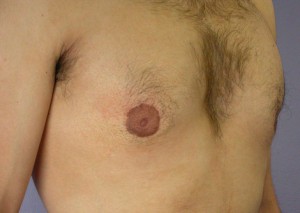 Male Breast Reduction Before and After