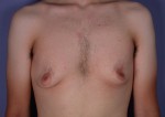 Male Breast Reduction Before and After Photo