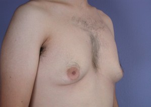 Male Breast Reduction Before and After