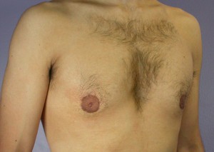 Male Breast Reduction Before and After