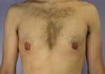 Male Breast Reduction Before and After Photo