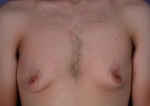 Male Breast Reduction Before and After Photo