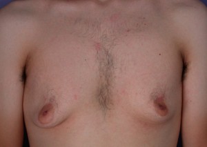 Male Breast Reduction Before and After