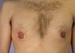 Male Breast Reduction Before and After Photo