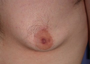 Male Breast Reduction Before and After