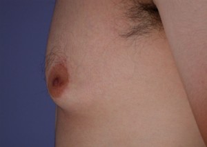 Male Breast Reduction Before and After