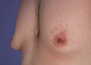 Male Breast Reduction Before and After