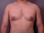 Male Breast Reduction Before and After Photo