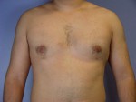 Male Breast Reduction Before and After Photo