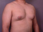 Male Breast Reduction Before and After Photo