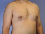 Male Breast Reduction Before and After Photo