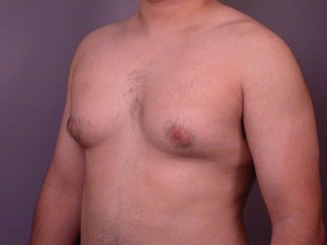 Male Breast Reduction Before and After