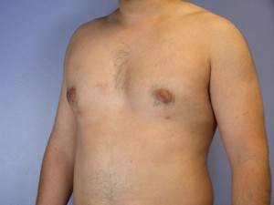 Male Breast Reduction Before and After