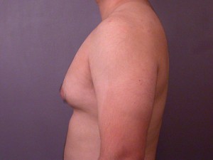 Male Breast Reduction Before and After