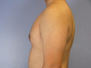 Male Breast Reduction Before and After