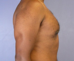 Male Breast Reduction Before and After