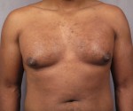 Male Breast Reduction Before and After Photo