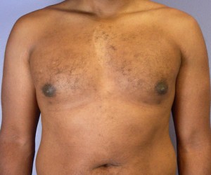 Male Breast Reduction Before and After