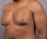 Male Breast Reduction Before and After Photo
