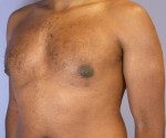 Male Breast Reduction Before and After Photo